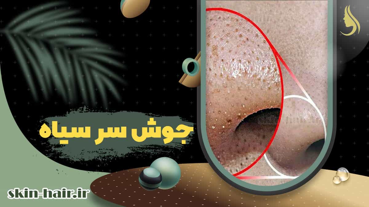 Blackheads