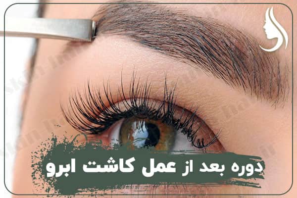 Postoperative period of hair transplantation