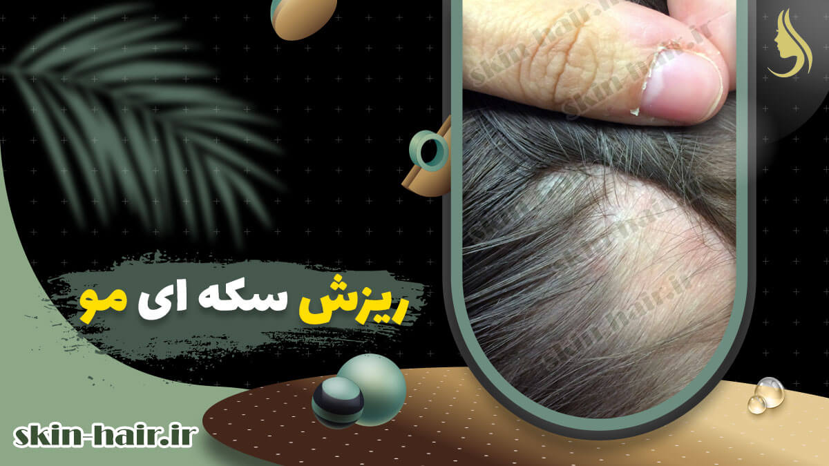 ریزش سکه ای مو