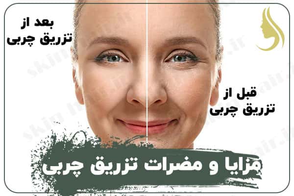 Benefits of fat injection