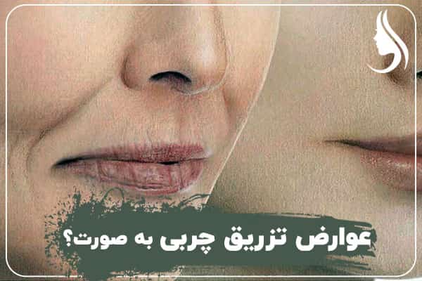 Complications of facial fat injection