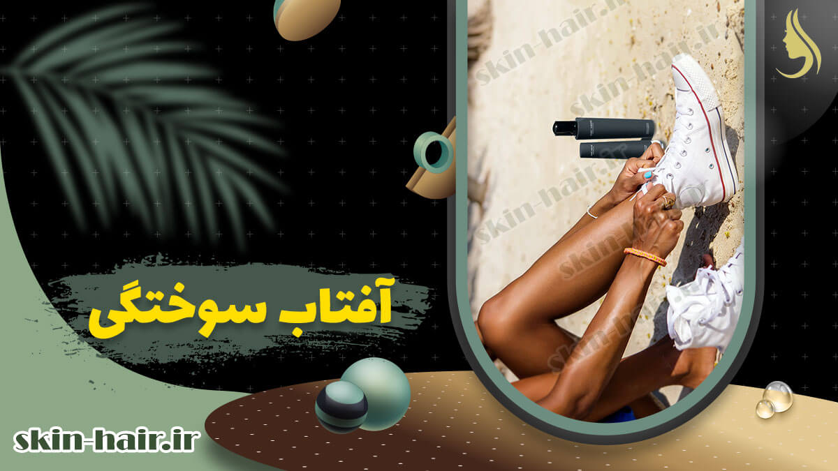 آفتاب سوختگی