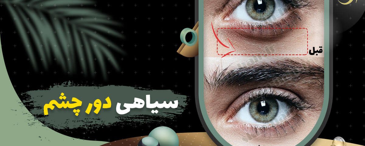 سیاهی دور چشم