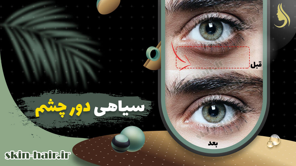 سیاهی دور چشم