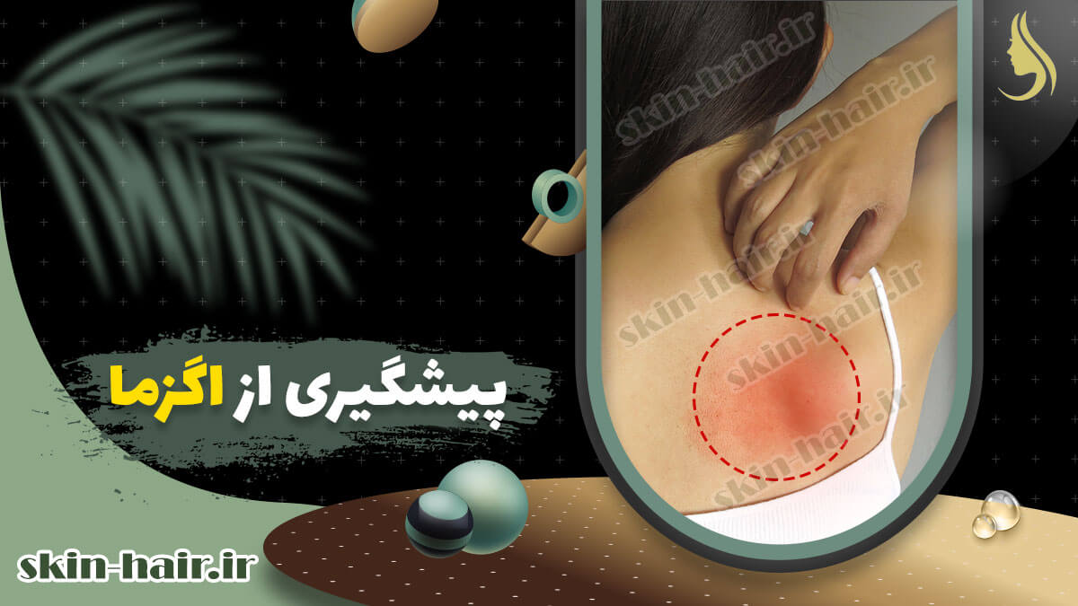 پیشگیری از اگزما