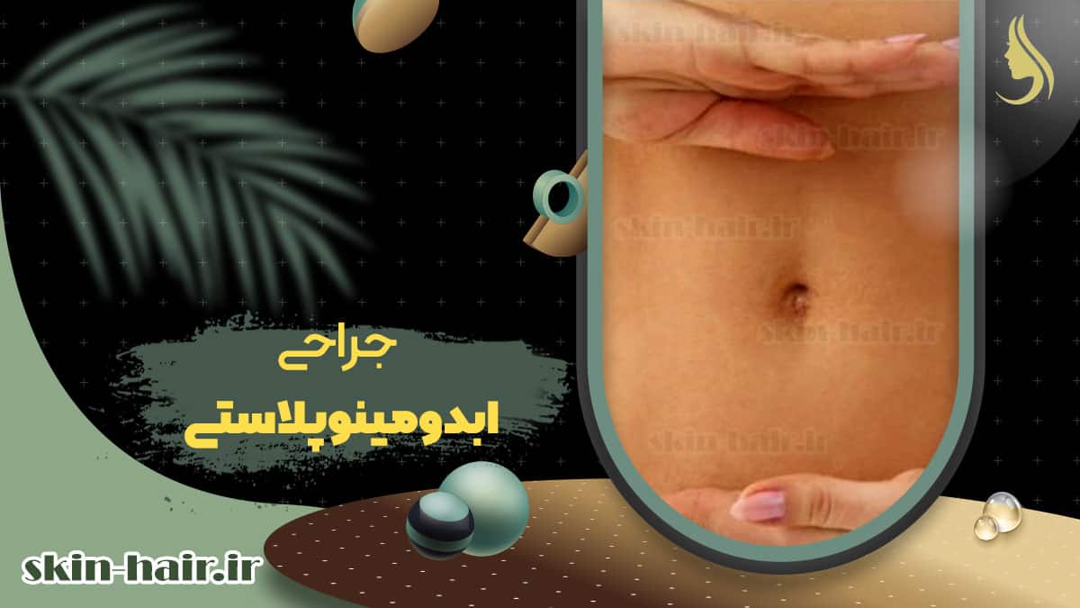 Abdominoplasty surgery