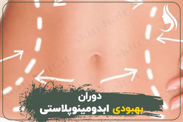 Recovery of abdominoplasty