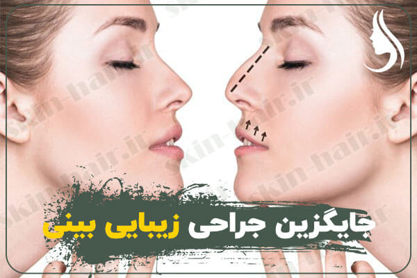 جایگزین-جراحی-زیبایی-بینی