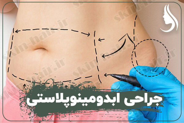 جراحی ابدومینو پلاستی