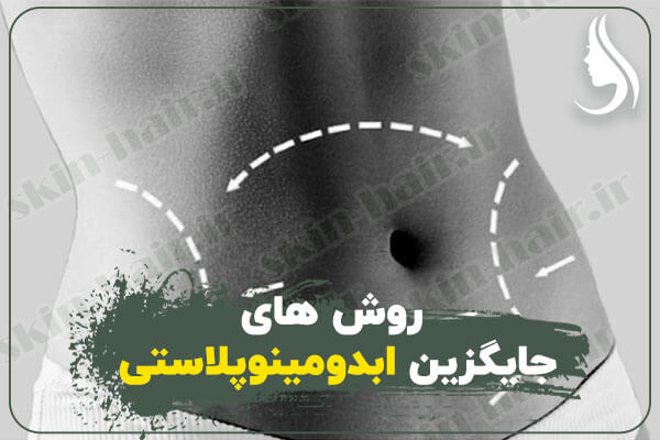 روش-های-جایگزین-ابدومینوپلاستی