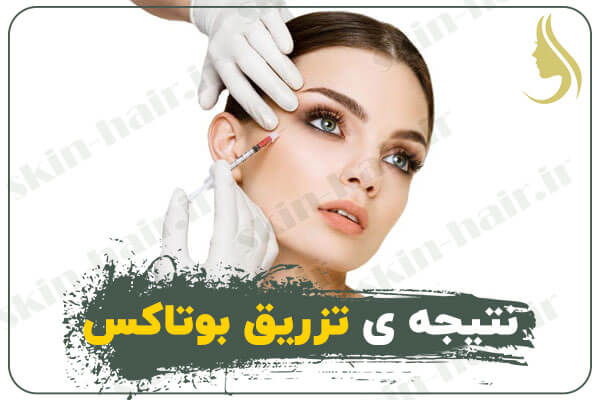 نتیجه-ی-تزریق-بوتاکس