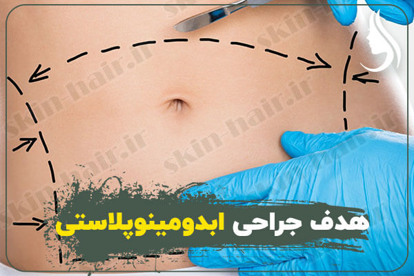 هدف-جراحی-ابدومینوپلاستی
