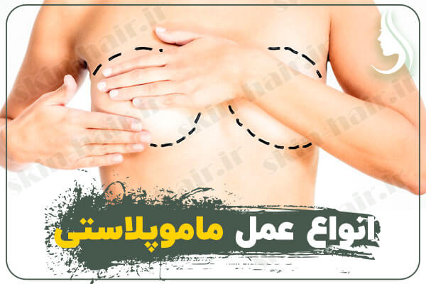 انواع عمل ماموپلاستی