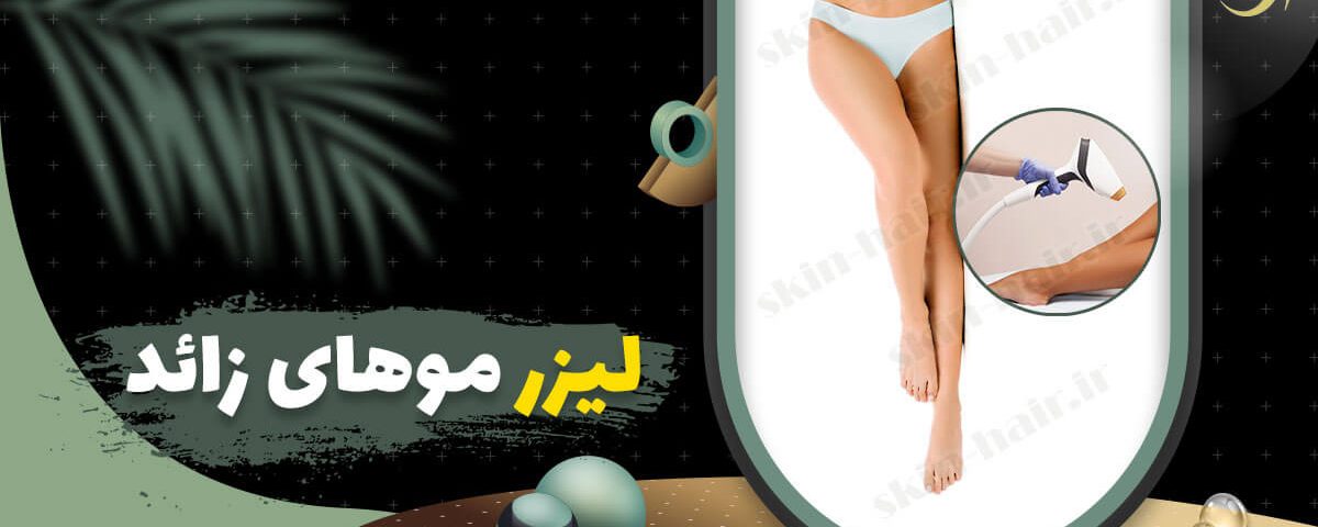 لیزر موهای زائد