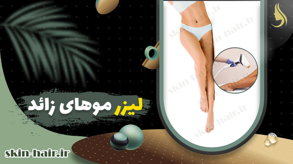 لیزر موهای زائد
