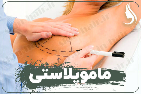 ماموپلاستی