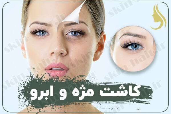 کاشت مژه و ابرو