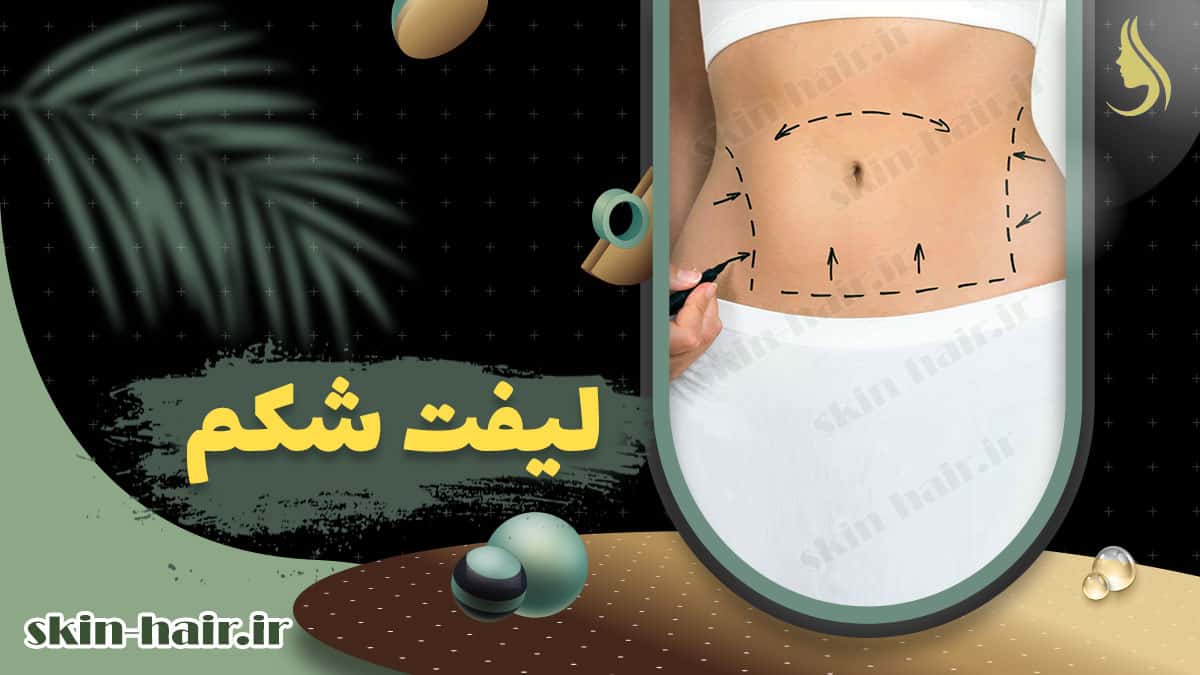 Abdominal lift