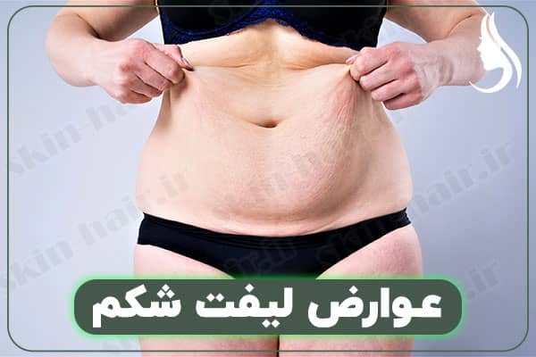 Complications of abdominal lift