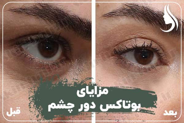 مزایای بوتاکس دور چشم
