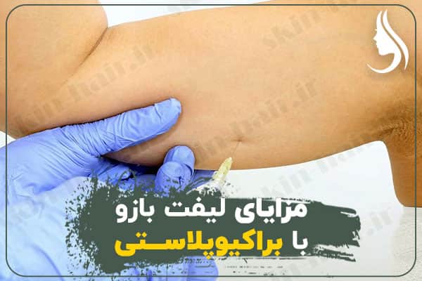 Benefits of brachioplasty