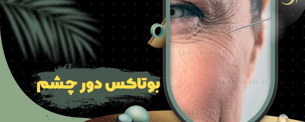 Botox around the eyes