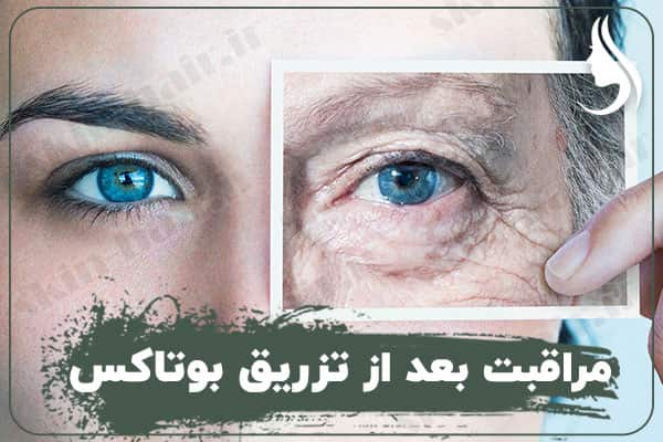 مراقبت های بعد از تزریق بوتاکس